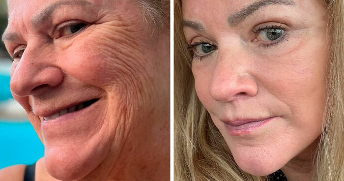 67 People Who Became Completely Unrecognizable After Getting Cosmetic Surgery In Turkey