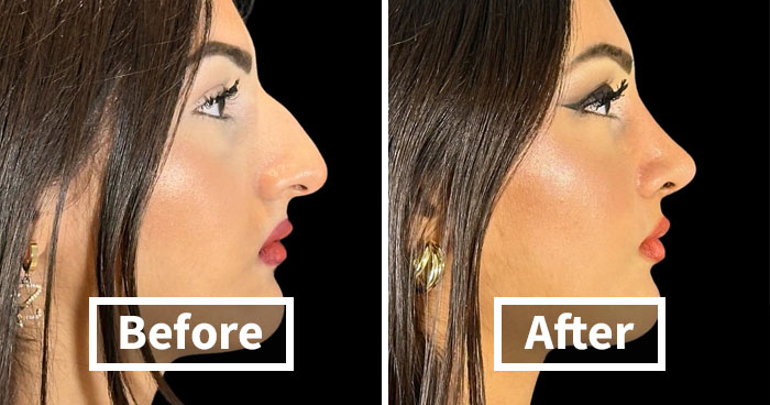 “Turning Back Time”: 50 Incredible Transformations From People Who Went Under The Knife To Change How They Look