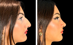 “Turning Back Time”: 50 Incredible Transformations From People Who Went Under The Knife To Change How They Look