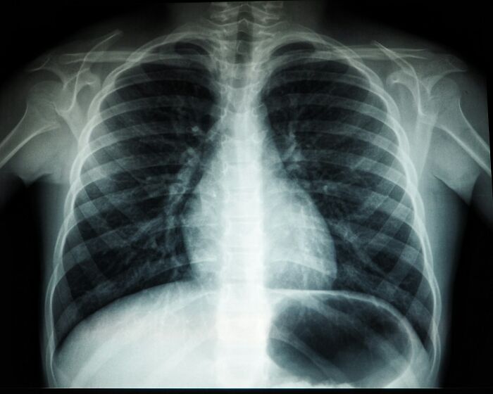 X-ray image showing human chest and ribs, illustrating intriguing life facts related to anatomy and health.