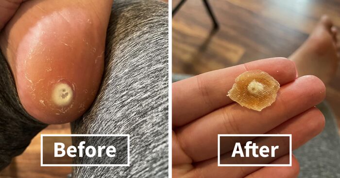 Close-up of a foot wart before removal and the wart afterward held between fingers showing a huge difference.