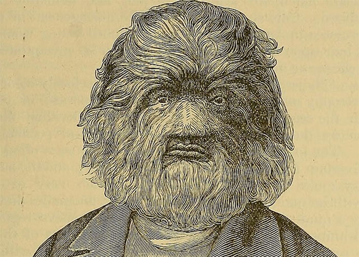 Vintage illustration of a man with hypertrichosis, a rare physiological trait causing excessive hair growth on the face.