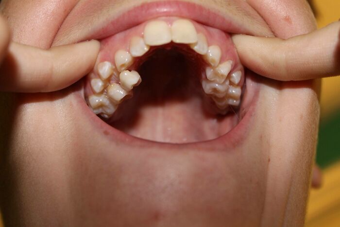 Close-up of rare physiological traits showing unusual dental formation inside a person's open mouth.