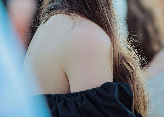 Close-up of a person's bare shoulder and long hair, highlighting a rare physiological trait in natural light.