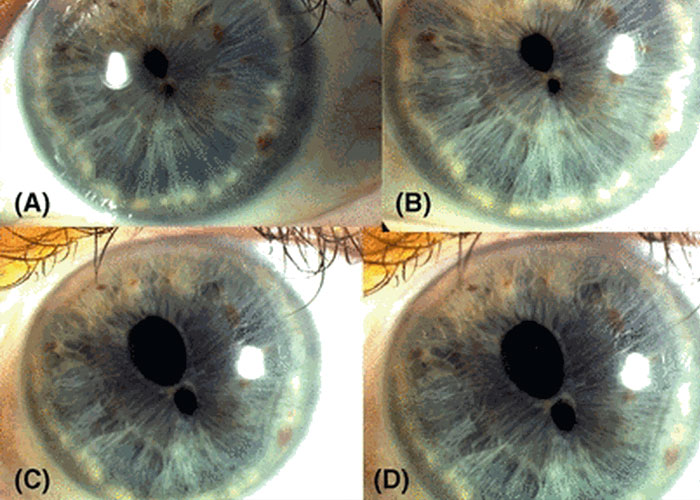 Close-up images of rare physiological eye traits showing unusual pupil shapes and iris patterns in detail.