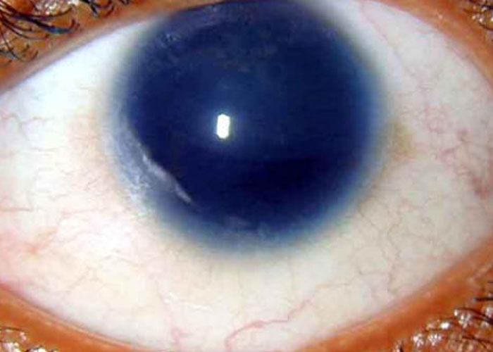Close-up of an eye showing a rare physiological trait featuring an unusually large and dark pupil.