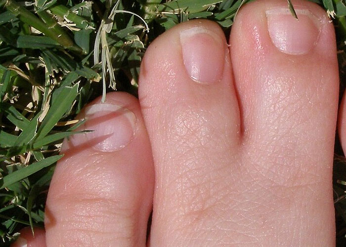 Close-up of a foot showing rare physiological traits, highlighting unusual toe structure and skin texture in natural light.