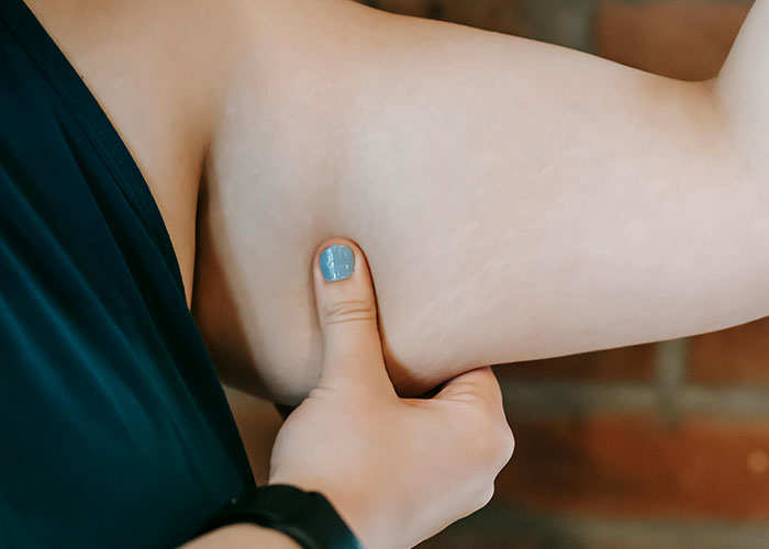 Close-up of a person pinching arm fat, illustrating themes related to medical professionals and patient interactions.