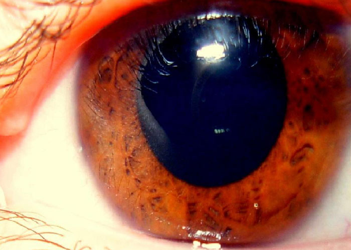 Close-up of a rare physiological trait showing detailed patterns in a brown eye rarely seen in person.