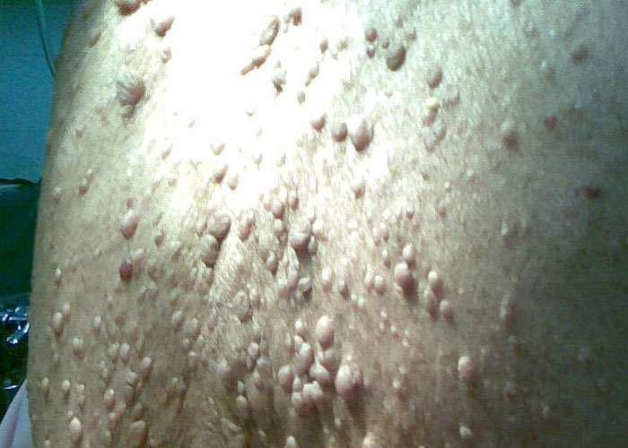 Close-up of a person's back showing rare physiological traits with multiple raised skin bumps and unusual texture.
