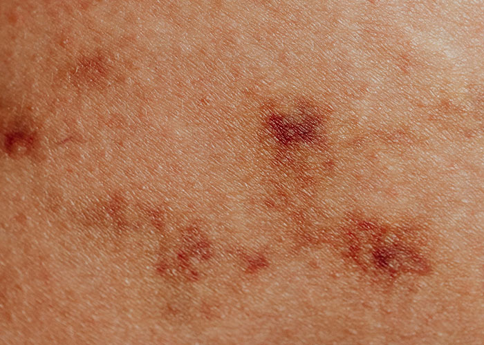 Close-up of rare physiological traits showing unusual skin markings and discoloration on human skin surface.