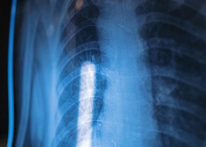 X-ray image showing rare physiological traits in the ribcage area, highlighting unique human anatomy details.