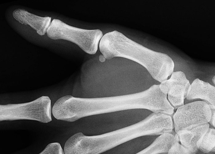 X-ray image showing a rare physiological trait of an unusual finger bone structure and alignment.