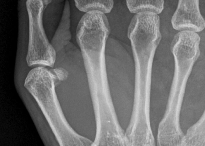 X-ray image showing a rare physiological trait in hand bones with an unusual bone growth on the finger.