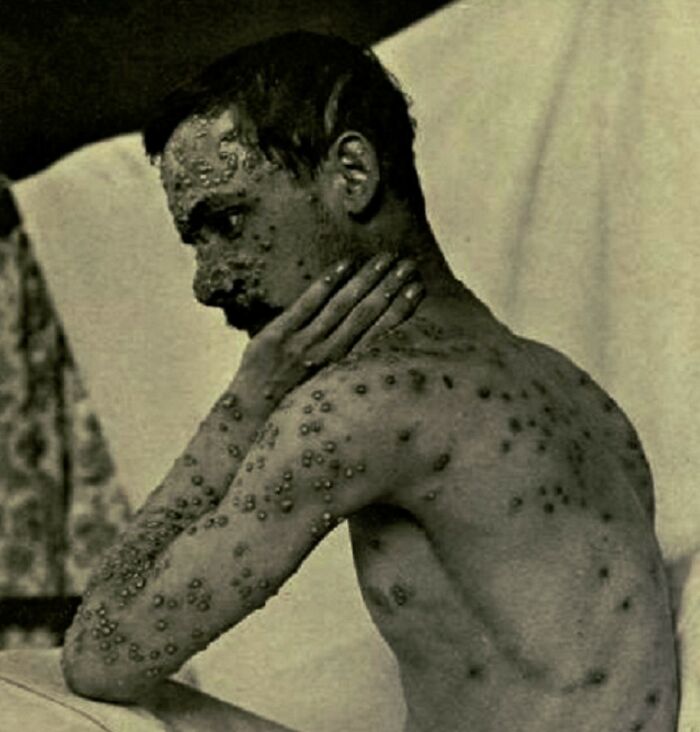 Man covered in sores sits pensively indoors, representing challenges similar to those faced in shipping containers.