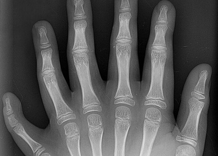X-ray image of a hand showing rare physiological traits in bone structure rarely seen in person.