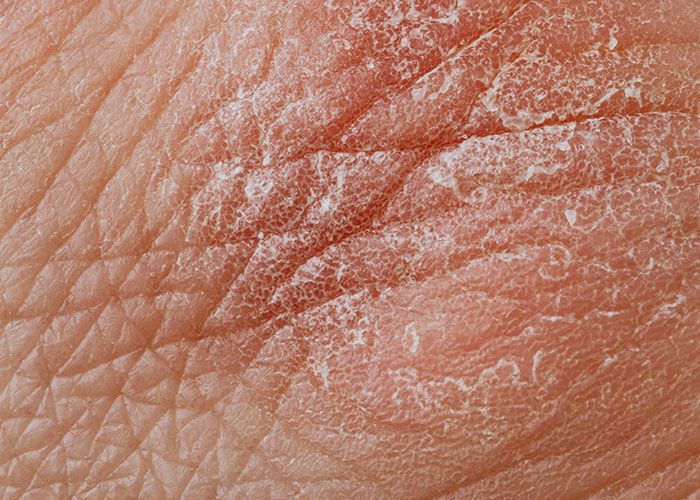 Close-up of rare physiological traits showing dry, c*****d skin texture not commonly seen in person.