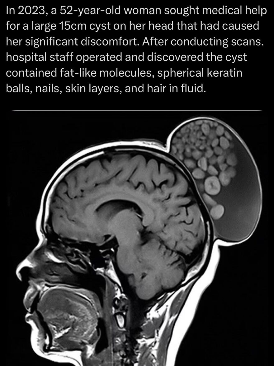 MRI scan showing a large cyst on the head with fat-like molecules and keratin balls, highlighting scary medical facts.