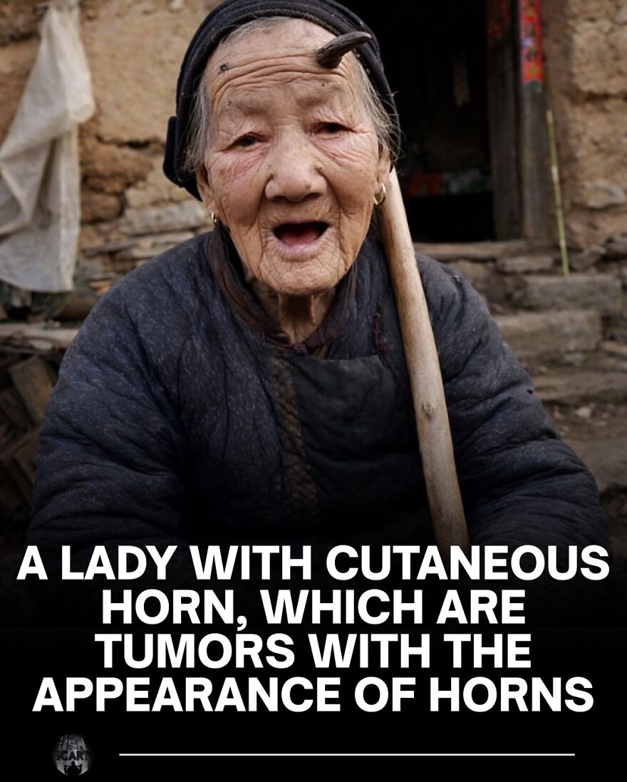 Elderly woman with a cutaneous horn tumor, illustrating scary facts about bones and health conditions.