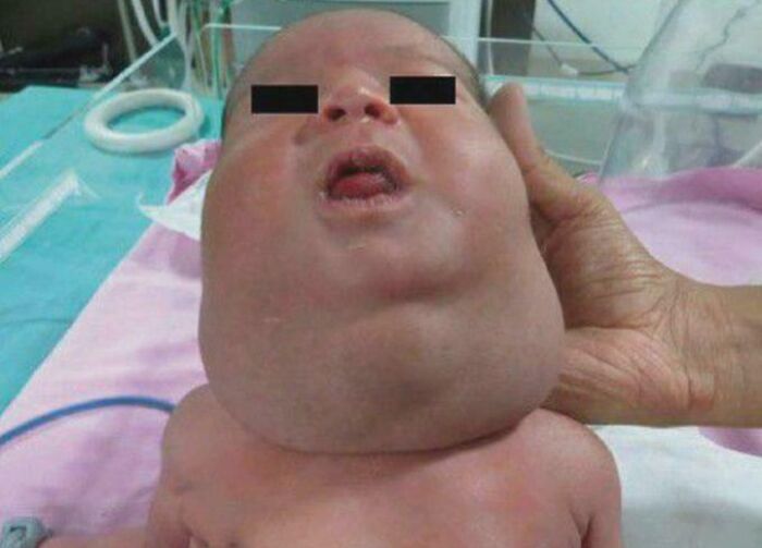 Newborn with massive neck swelling supported by hand in hospital neonatal bed, medical pics
