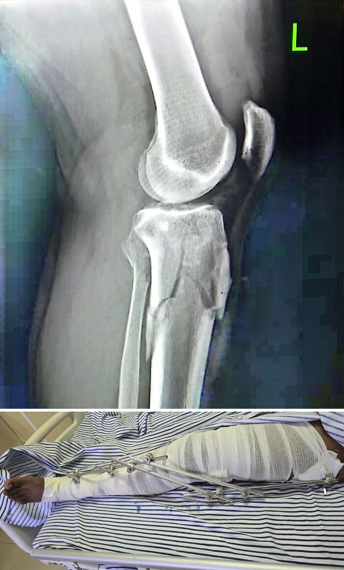 Medical pics: X-ray of comminuted femur fracture near knee and patient's leg in plaster with external fixation rods.