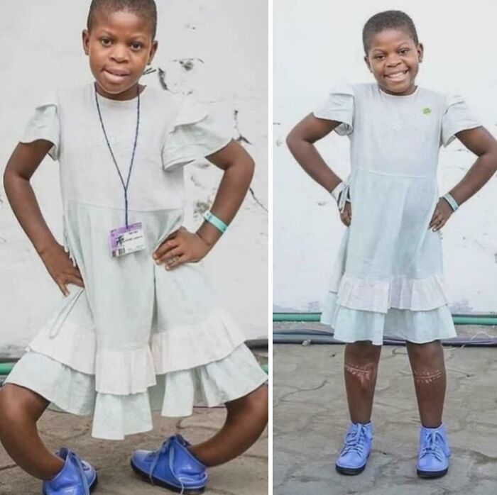 Young girl in white dress and blue shoes posing in two photos, showing bowed legs and leg markings, medical pics