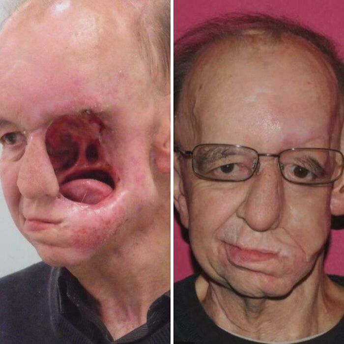 Before and after facial reconstruction of man with severe cheek and eye loss, medical pics