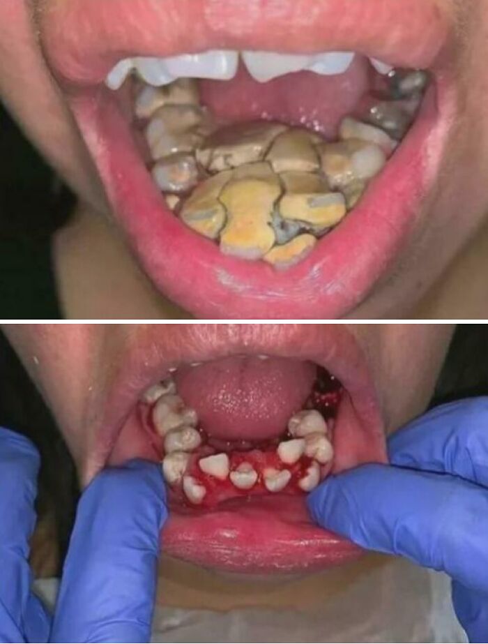 Two medical pics showing severe dental calculus buildup and lower tooth extractions with bloody gums and gloved hands.