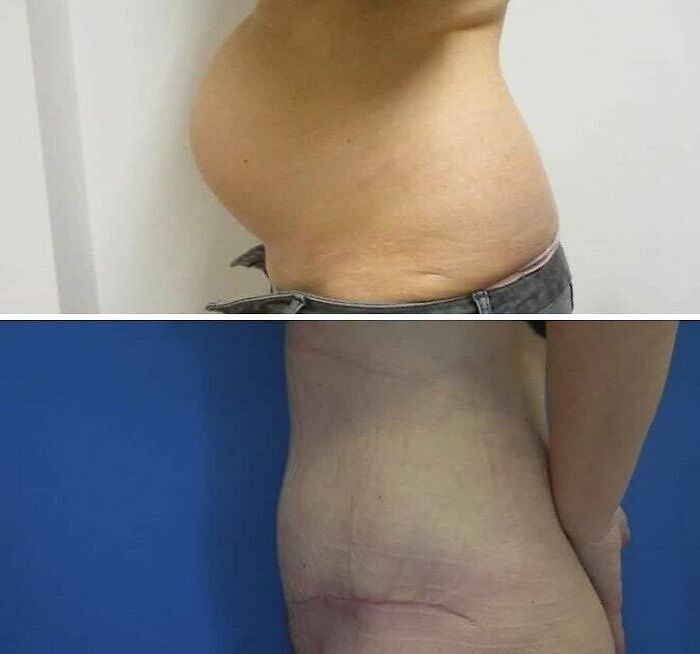 Before and after medical images showing dramatic abdomen transformation with visible scar in unnerving medical pics.