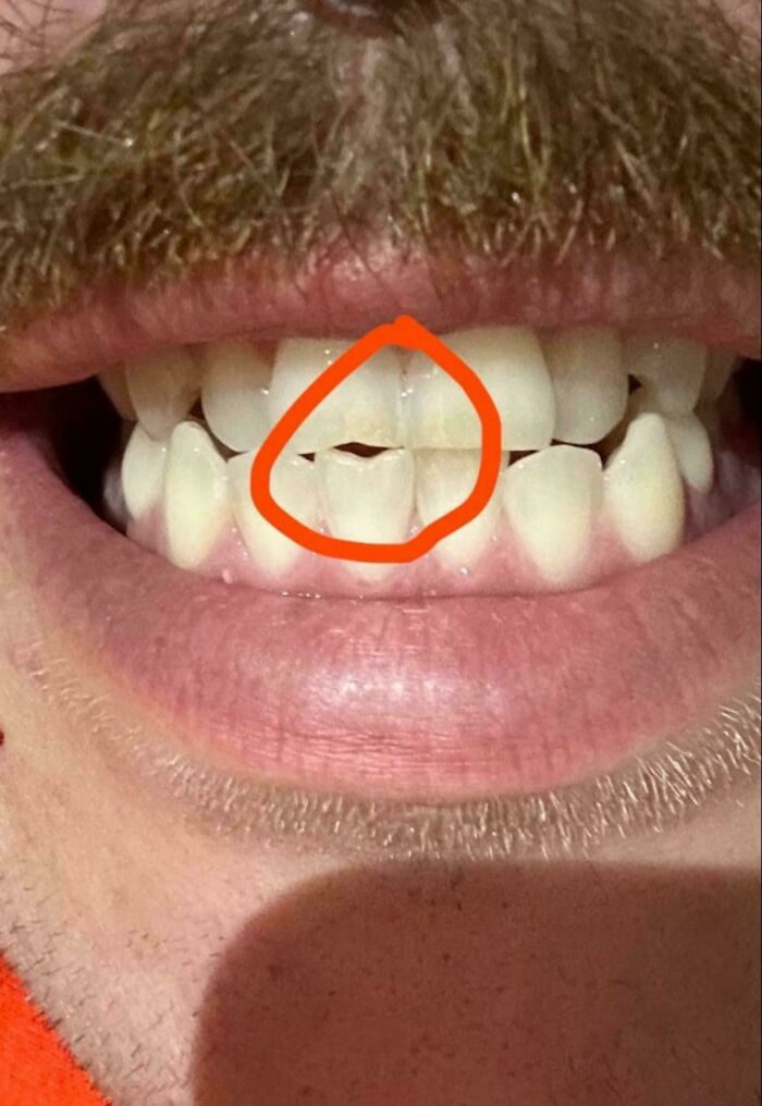 Close-up of worn down teeth with a chip highlighted in red, showing everyday objects worn down in unexpected ways.