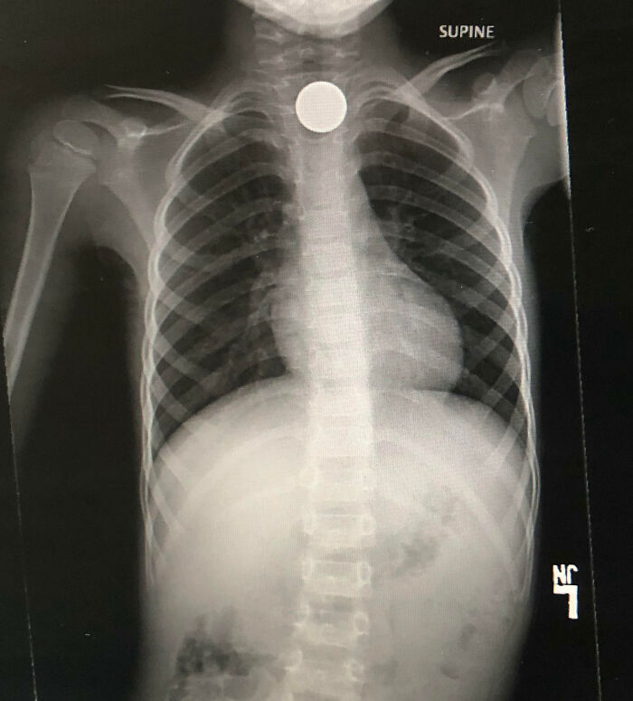 X-ray showing a round object stuck in the chest, one of the unfortunate and expensive fails caught on medical imaging.