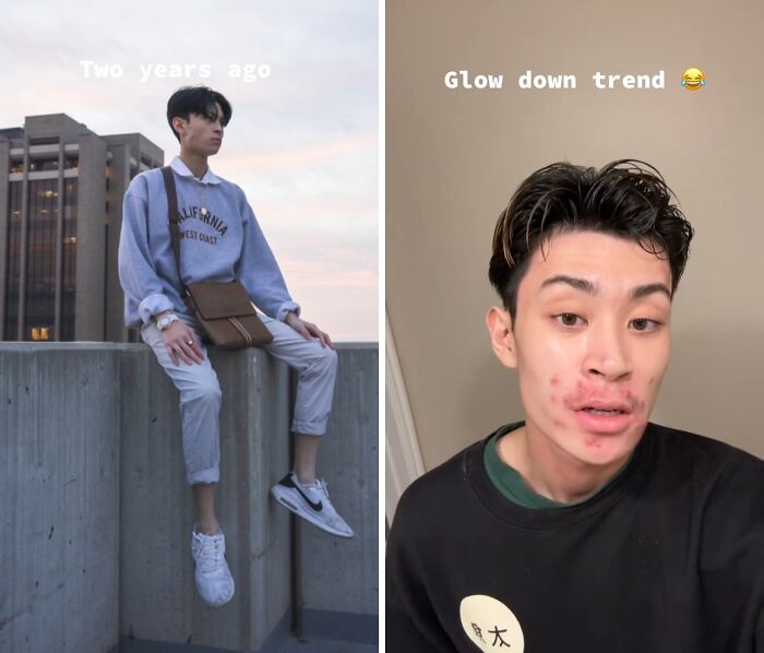 Young man showing a glow down transformation with acne and changed appearance over a two-year period.