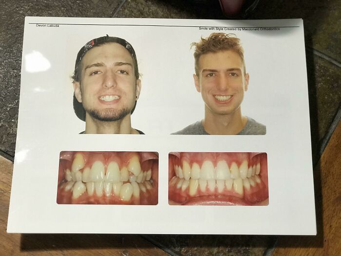 Before and after pics showing dramatic teeth and smile transformation with improved alignment and brightness.