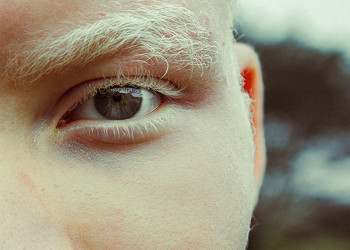 Close-up of a person's eye and eyebrow showing rare physiological traits with pale skin and light hair details in natural light.