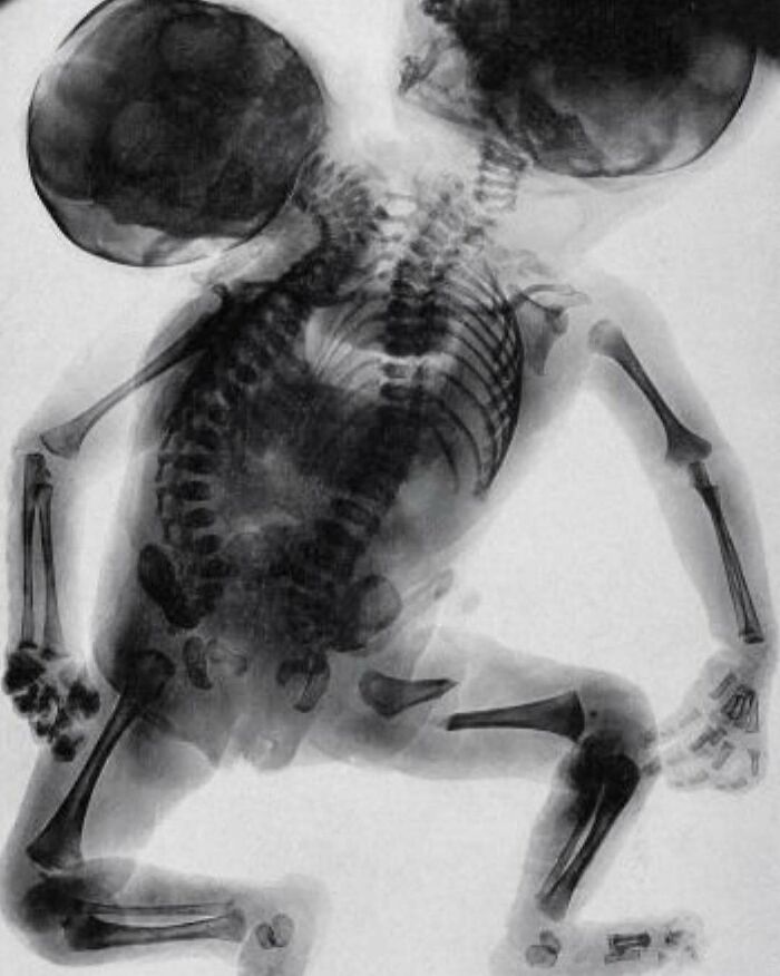 X-ray image showing conjoined twins with fused skeletons, an unnerving and fascinating medical pic to process.