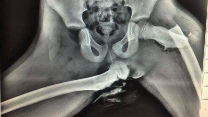 X-ray image showing a severe femur fracture, illustrating one of the most unnerving medical pics to process.