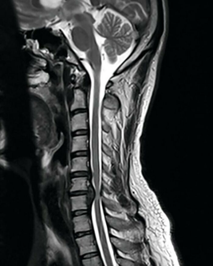 MRI scan showing detailed spinal cord and brainstem anatomy in a fascinating and unnerving medical pic.