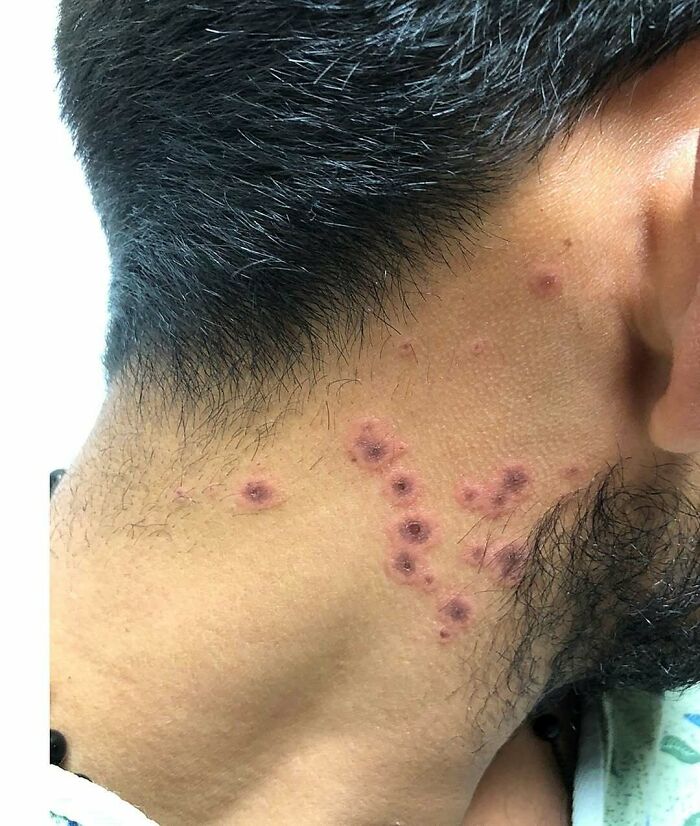 Close-up of a male neck with multiple red, inflamed medical skin lesions in a medical pic showing a skin condition.