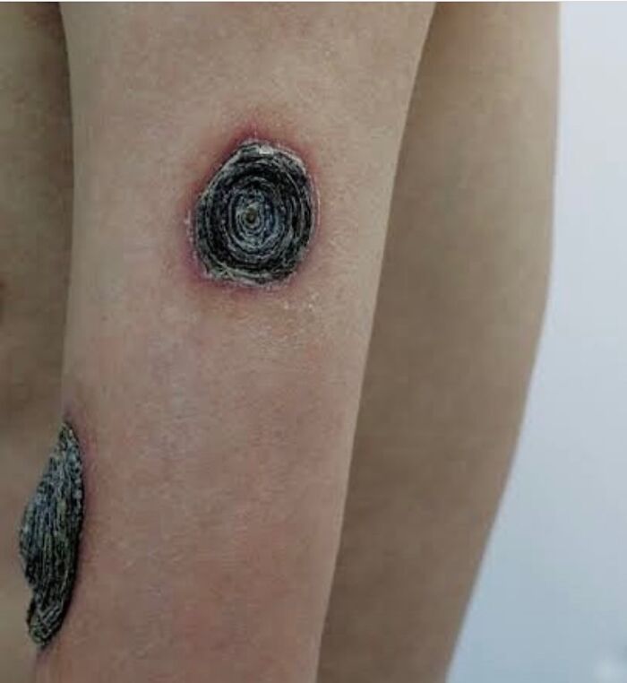 Close-up of unnerving medical skin condition showing circular dark lesions on arm with surrounding redness and irritation.