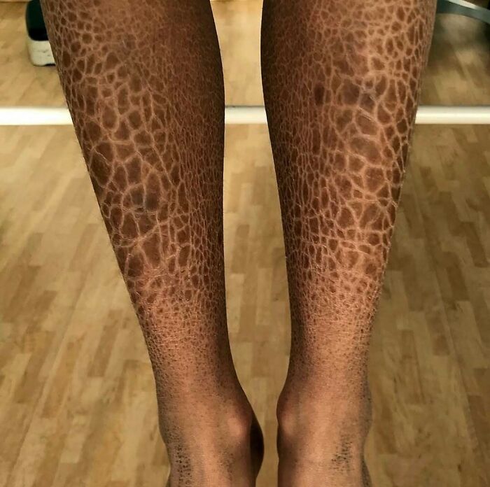 Close-up of legs showing an unnerving medical skin condition with a complex textured pattern on the lower legs.
