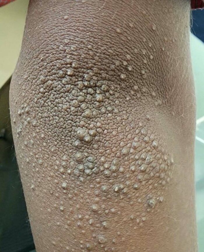 Close-up of human skin covered in numerous raised bumps, a fascinating and unnerving medical condition pic.