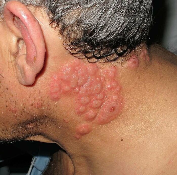 Close-up of a person's neck with unnerving medical skin lesions and inflamed blisters in a fascinating medical image.