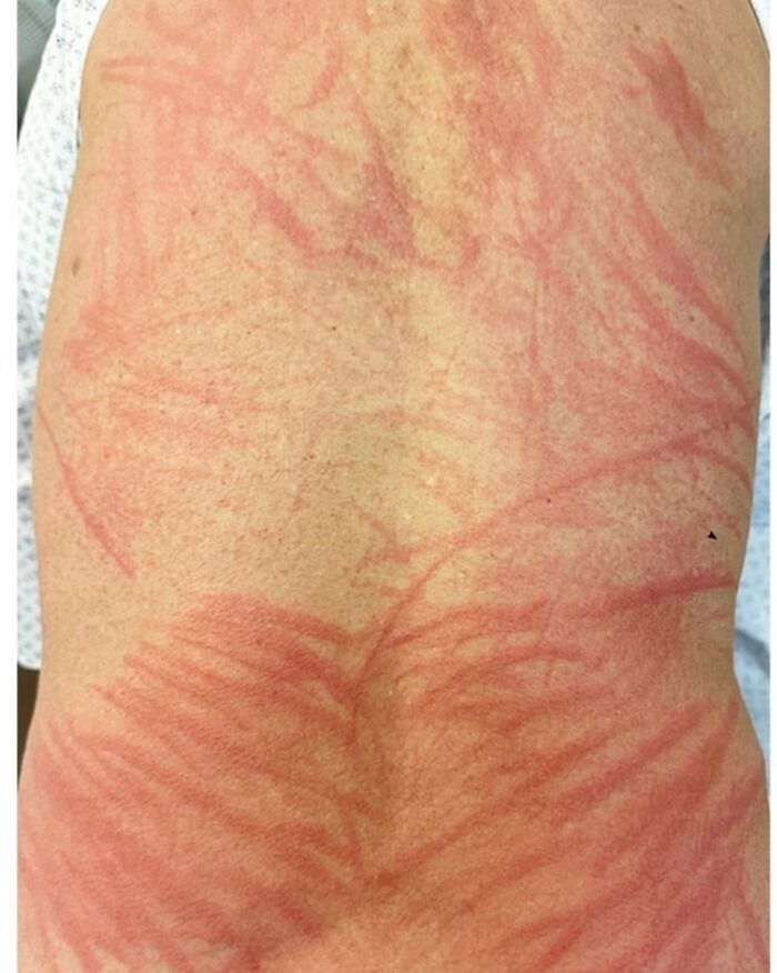 Red, irritated skin with unusual patterns on the back, a fascinating and unnerving medical pic to process.