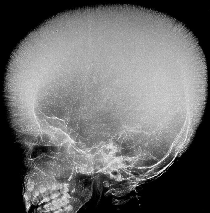 X-ray image of a human skull showing abnormal bone growth and texture in a fascinating and unnerving medical pic.