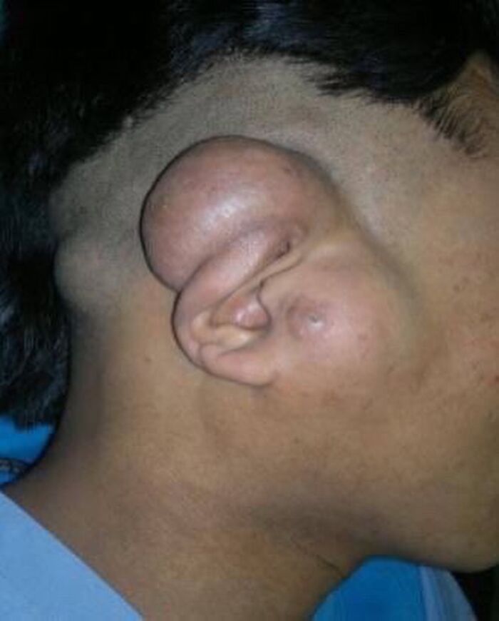 Swollen and deformed ear of a person showing an unusual medical condition in a fascinating and unnerving medical pic.