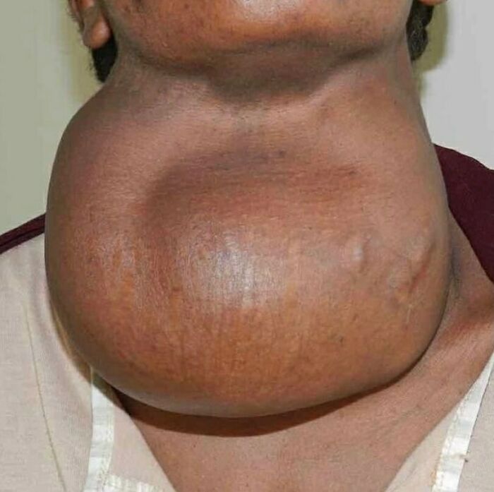 Large, swollen neck tumor on a person, showing a disturbing and unnerving medical condition close-up.