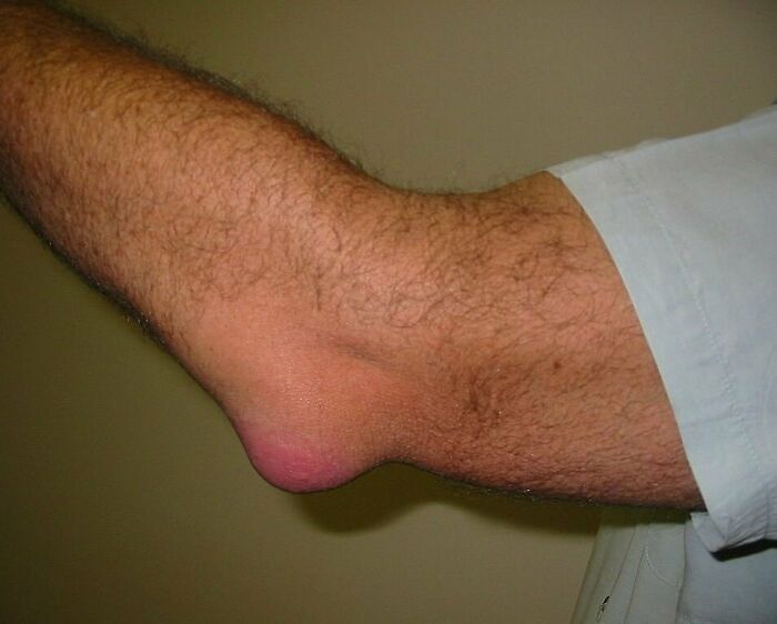 Close-up of an inflamed elbow showing a swollen, red area in a medical image illustrating fascinating and unnerving medical pics.