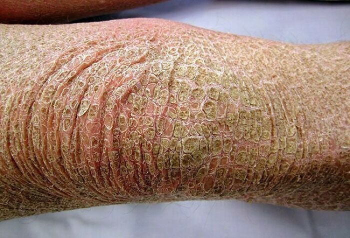 Close-up of unnerving medical skin condition showing severe scaling and cracking, a fascinating medical pic to process.