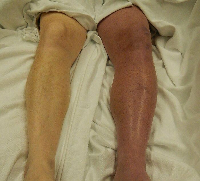 Legs side by side showing visible swelling and discoloration, illustrating unnerving medical condition in a clinical setting.