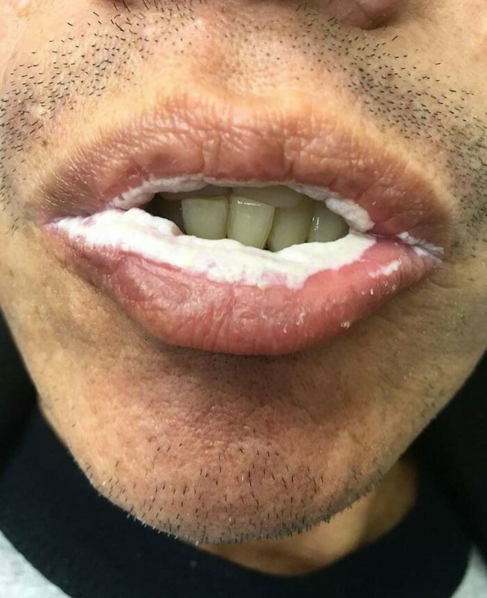 Close-up of lips with white fungal infection around the mouth, shown in an unnerving medical pic to process.